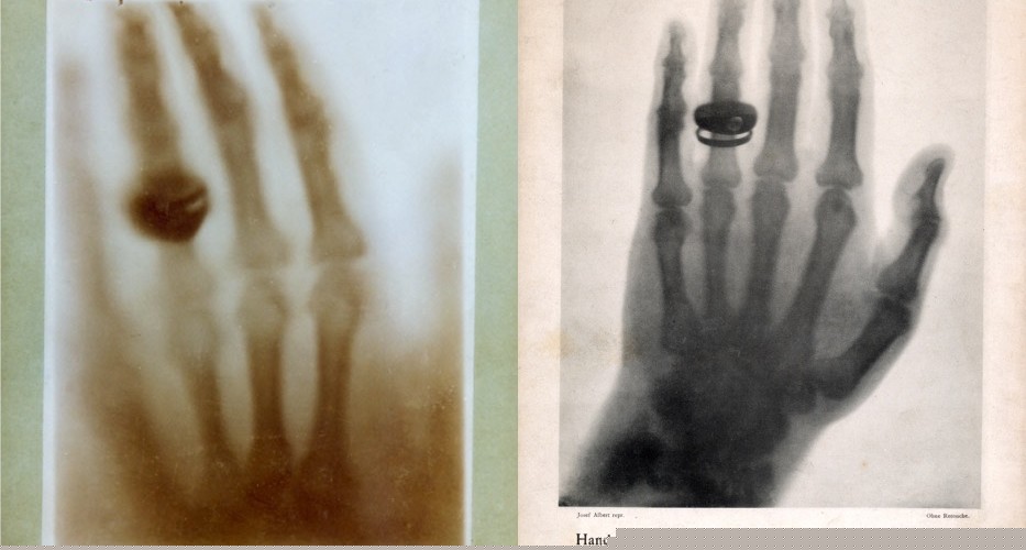 X-ray of hands – the first ever X-ray images